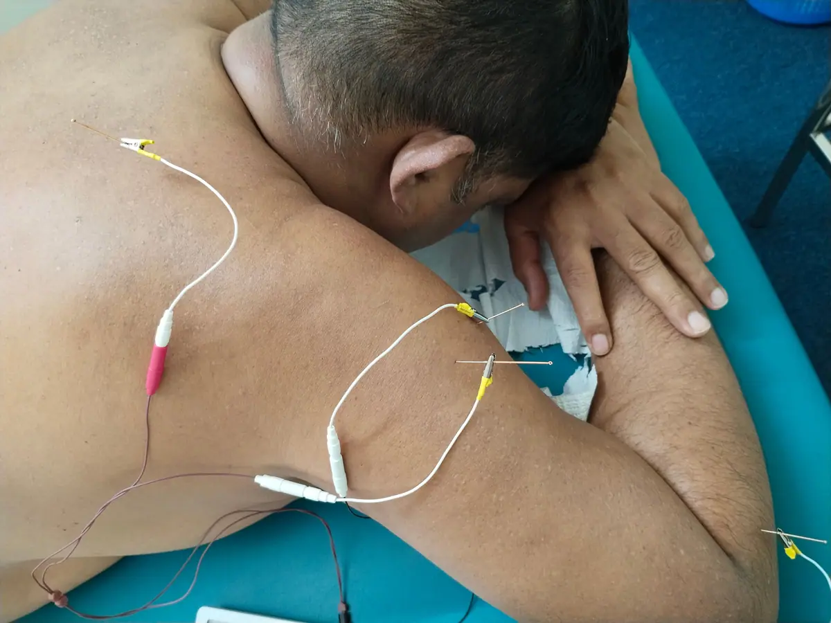 Fine dry needling needles placed in the muscles of a patient’s upper back and shoulder, connected to electrical stimulation leads during treatment